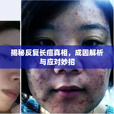 揭秘反復(fù)長(zhǎng)痘真相，成因解析與應(yīng)對(duì)妙招