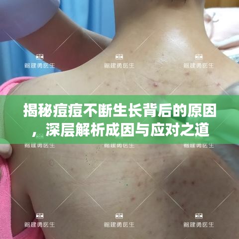 揭秘痘痘不斷生長背后的原因，深層解析成因與應對之道